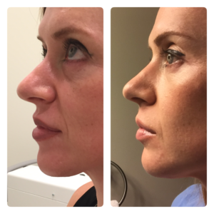 Botox® Fillers Lasers Aesthetics Calgary Botox® Fillers Lasers Aesthetics Calgary