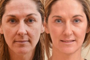 Botox® Fillers Lasers Aesthetics Calgary Botox® Fillers Lasers Aesthetics Calgary